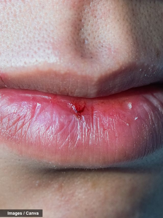 Remedies for hyposalivation