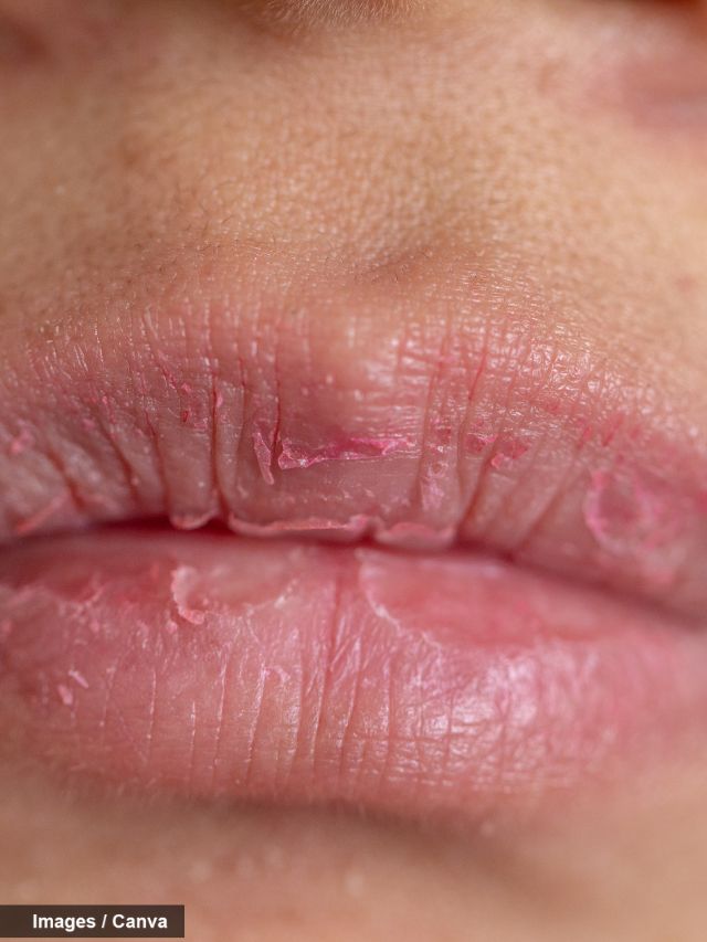 To keep the mouth wet and alleviate the dry mouth condition, the expert suggests the following remedies.